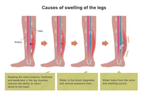 legs leaking fluid|Edema: What It Is, Possible Causes, Symptoms